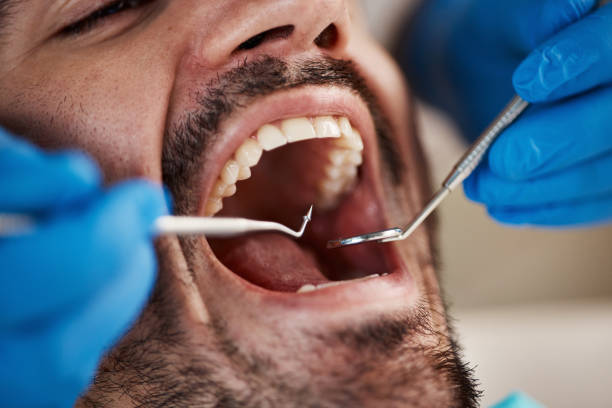 Best Emergency Wisdom Tooth Extraction in Black Diamond, WA